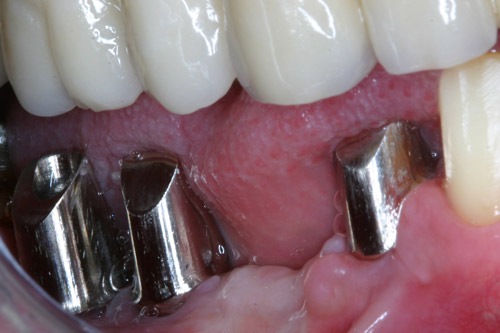 Impianti in resina: scopri i vantaggi dell'implantologia dentale - Studio  Dentistico Dott. Gramaglia
